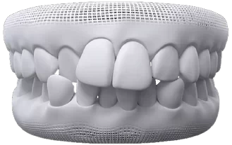 Modelo 3D de arcada com os dentes da frente encavalados
