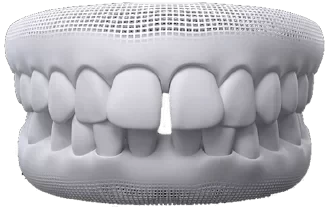 Modelo 3D de arcada com espaço entre os dentes da frente