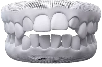 Modelo 3D de arcada em que os dentes da frente não se tocam com a boca fechada