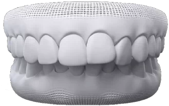 Modelo 3D de arcada com mordida profunda, os dentes de cima cobrindo os de baixo