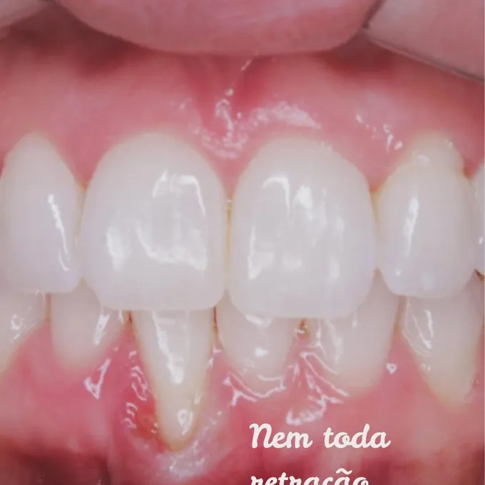 Nem toda retração gengival vem da escovação
