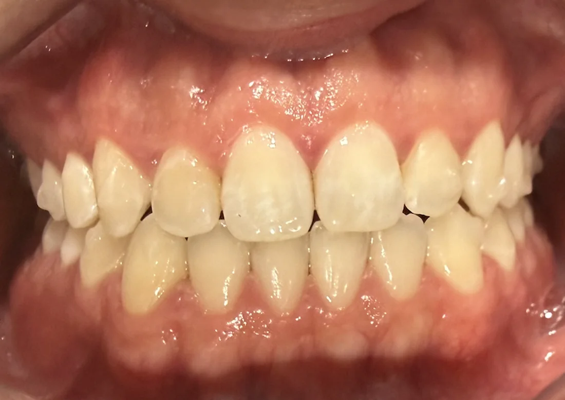 Antes do tratamento com Invisalign