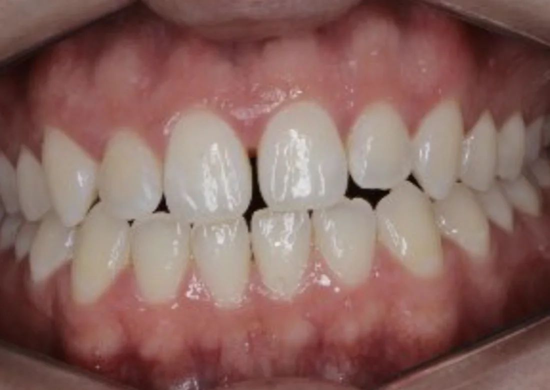 Depois do tratamento com Invisalign