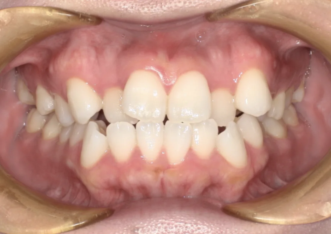 Antes do tratamento com Invisalign