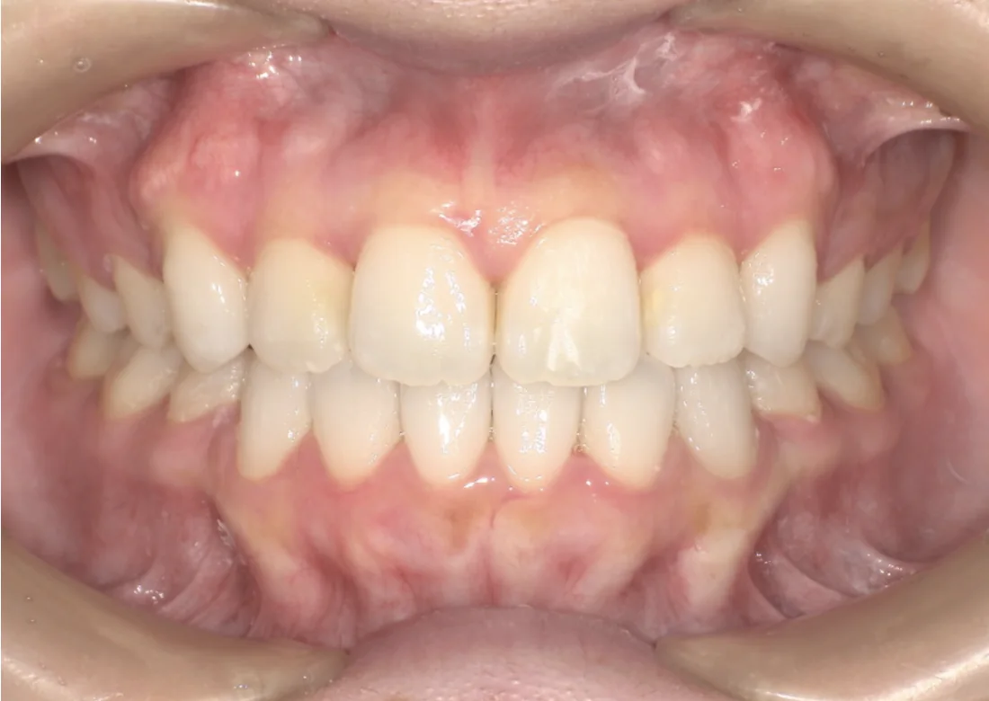 Depois do tratamento com Invisalign