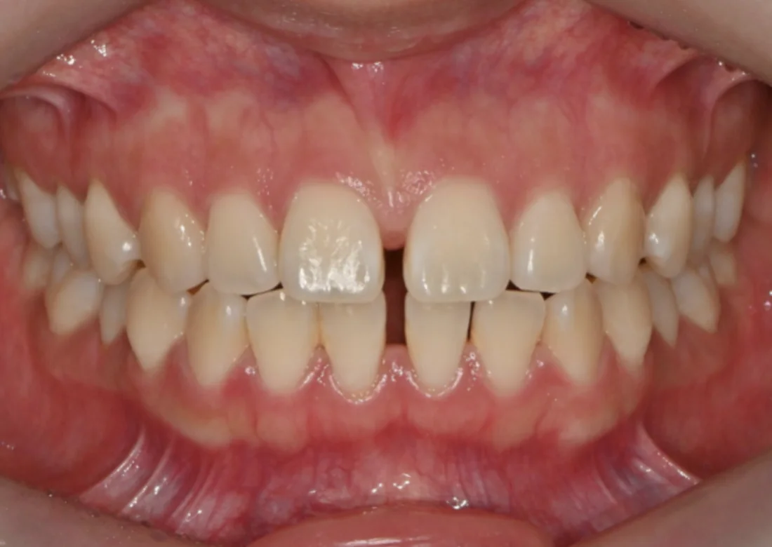 Antes do tratamento com Invisalign