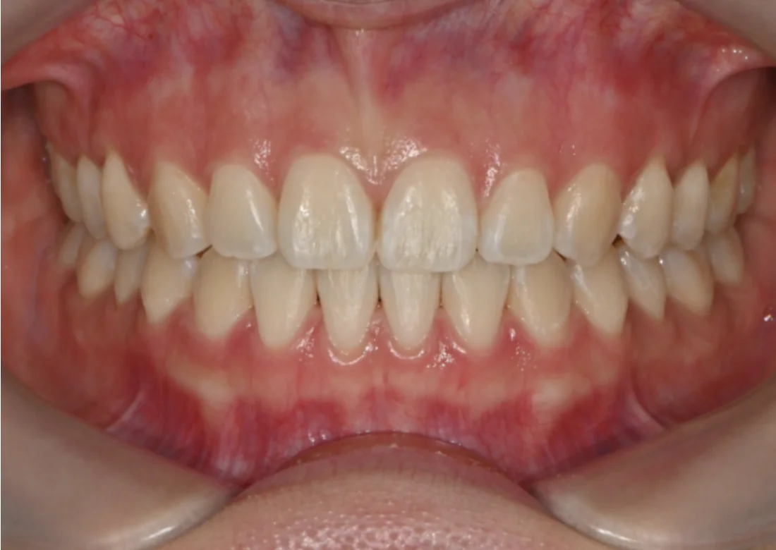 Depois do tratamento com Invisalign