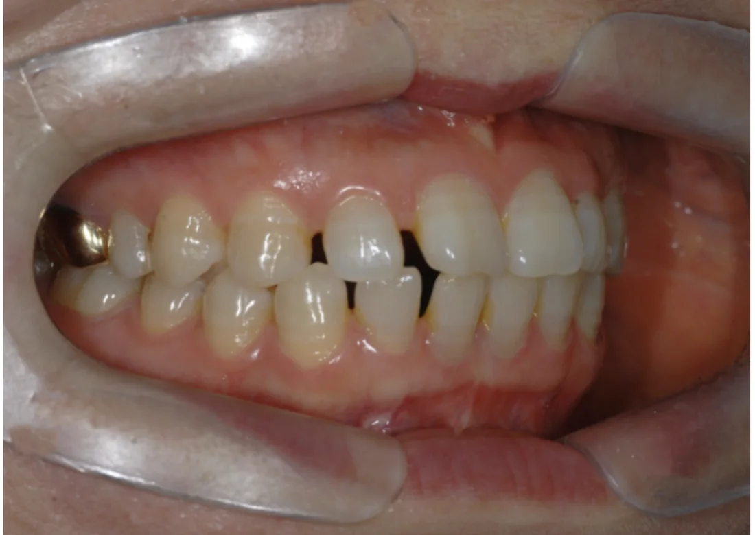 Antes do tratamento com Invisalign