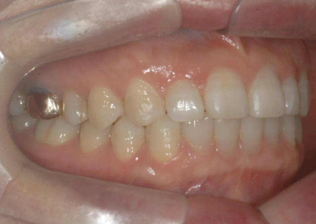 Depois do tratamento com Invisalign