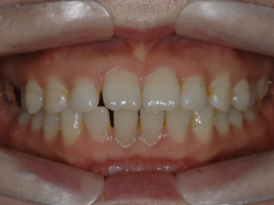 Registro intraoral de acompanhamento