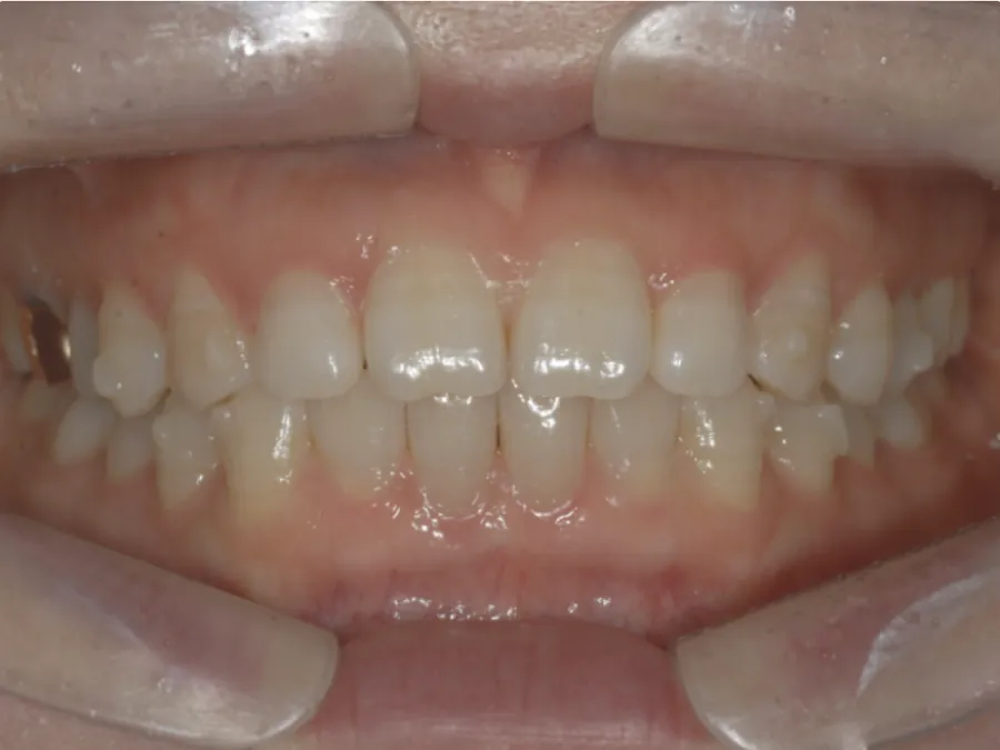 Registro intraoral de acompanhamento